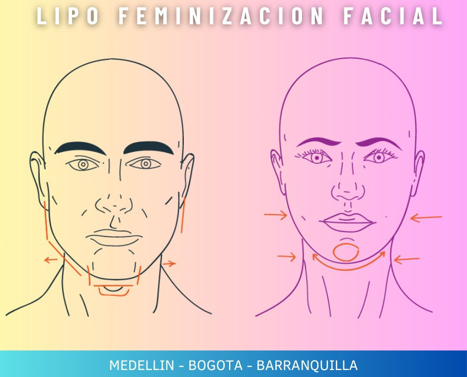FFS FEMINIZACION FACIAL LIPO BARRANQUILLA BOGOTA MEDELLIN AMY.jpeg