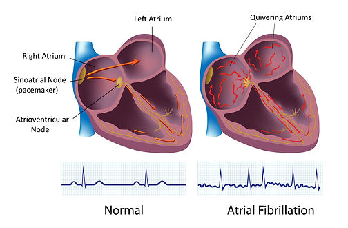 AFIB_with_strip.jpeg