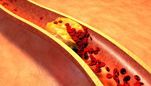cholesterol_in_artery.jpeg