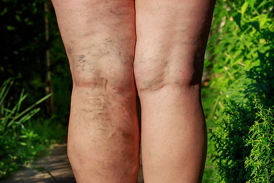 Spider Veins