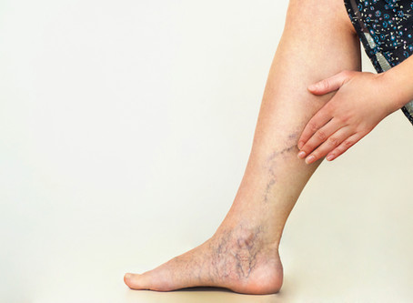 We Can Get Rid of Your Spider Veins