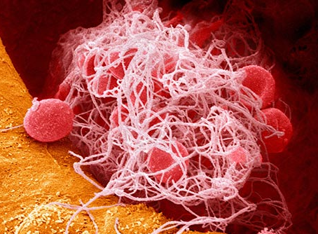 Blood Clot Symptoms to Know