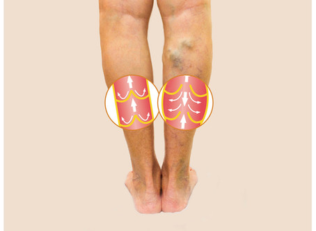 Phlebectomy For Varicose Veins