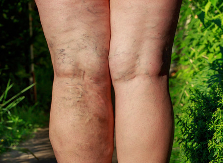 Endovenous Chemical Thermal Ablation (Laser Therapy)