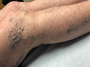 Spider Veins
