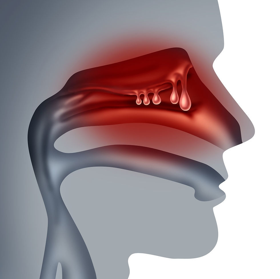 Imagem em corte transversal dos seios da face humana com pólipos nasais em um estilo de ilustração 3D.