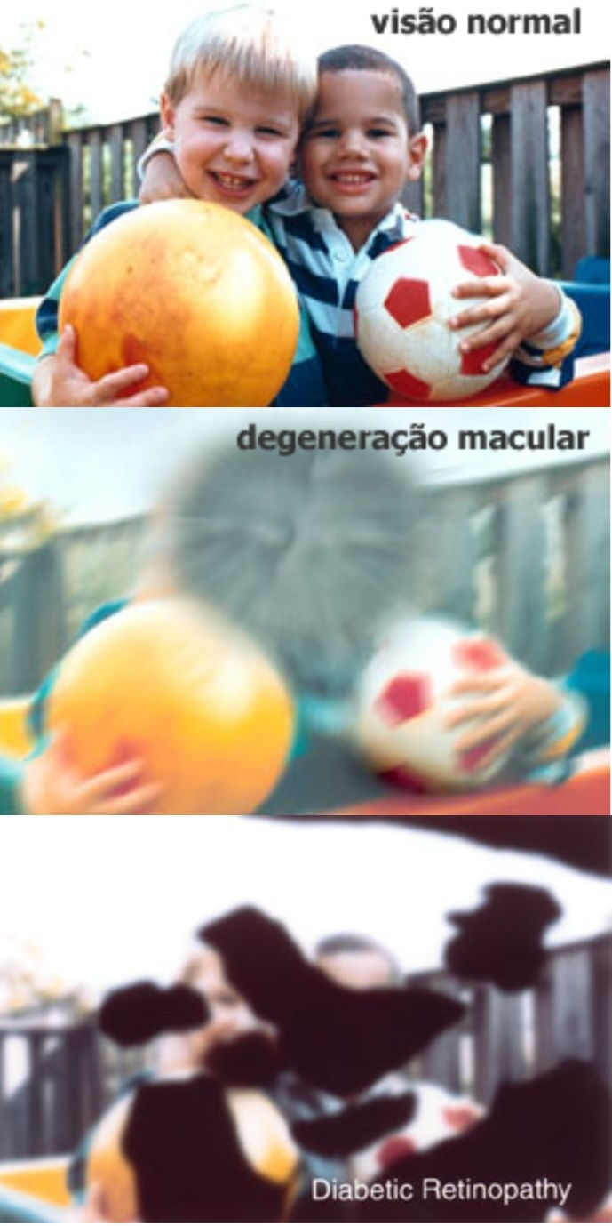 QUAIS SÃO OS DESAFIOS DA BAIXA VISÃO? 
