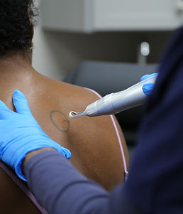 laser tattoo removal