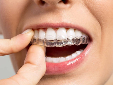 Are Clear Self Ligating Braces Right for You? A Plymouth MI Guide