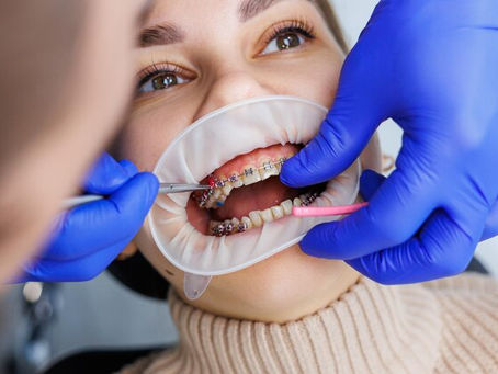 How a Farmington Hills Orthodontist Helps You Choose the Right Braces