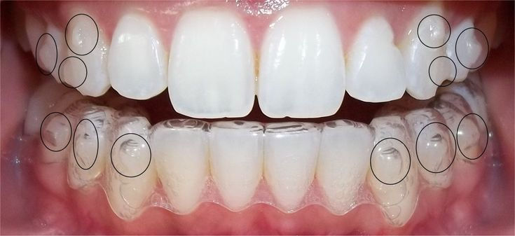 How Much Does Invisalign Cost in Livonia, MI for Adults?