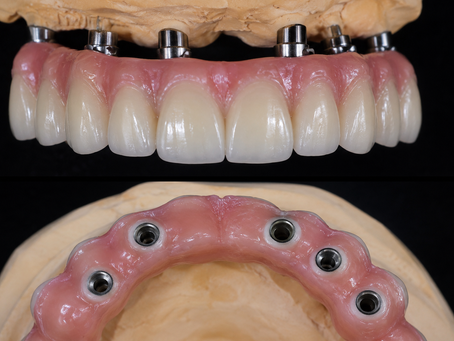 Prothèse provisoire fixe après la pose d’un All-on-6 au Portugal pour refaire ses dents