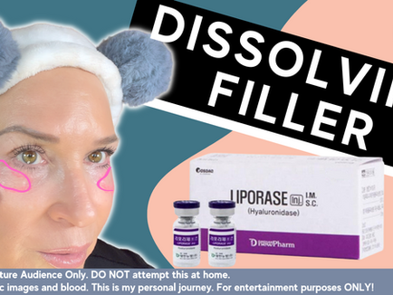 Why Did I Dissolve My Under Eye Filler 