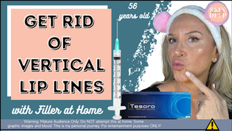 I Filled Lip Lines (Smokers' Lines) Instantly With Dermal Filler