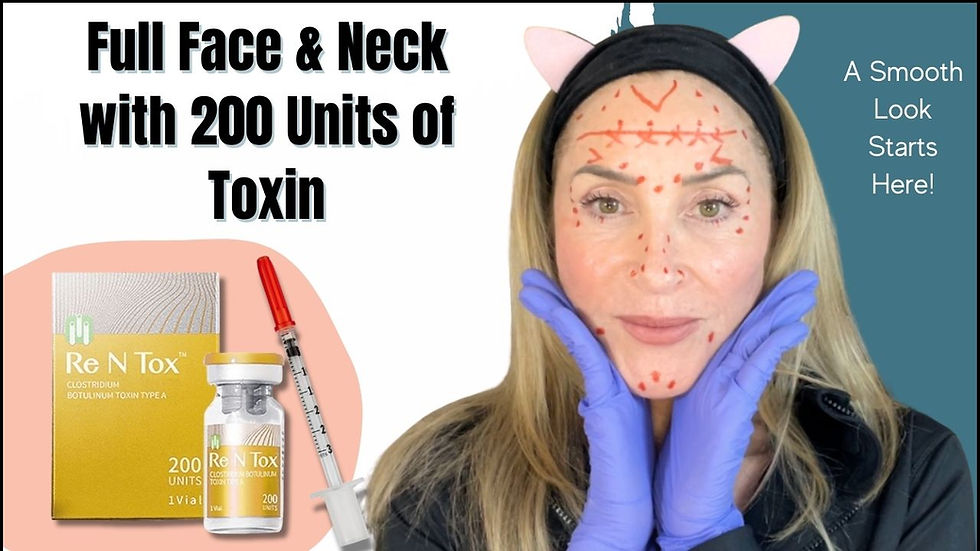 BOTOX: 200 Units of Tox in Face, Neck & Traps