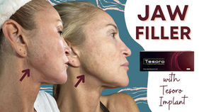FILLER: Jaw Filler (Bolus Injections & Cannula)