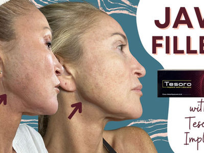 FILLER: Jaw Filler (Bolus Injections & Cannula)