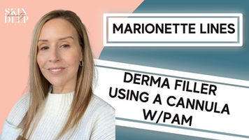 FILLER: Smoothing Mariotte Lines with Filler Using a Cannula w/PAM