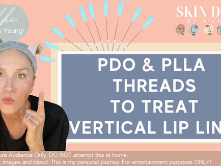 PDO THREADS - How I Used Them To Treat My Vertical Lip Lines