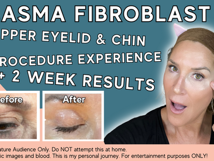 Plasma Fibroblast Tightens Loose Skin Without Invasive Surgery! See My Amazing Results! 