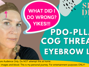 PDO, PLLA COG Threads - Eyebrow Lift
