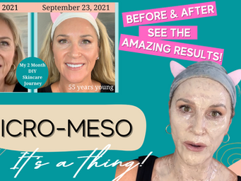 Micro - Meso, Yes it's a Thing. Microneedling Skin Boosters!