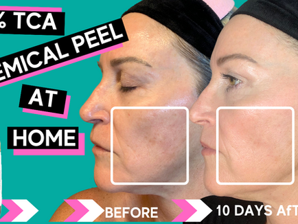 TCA Chemical Peel, Before & After 