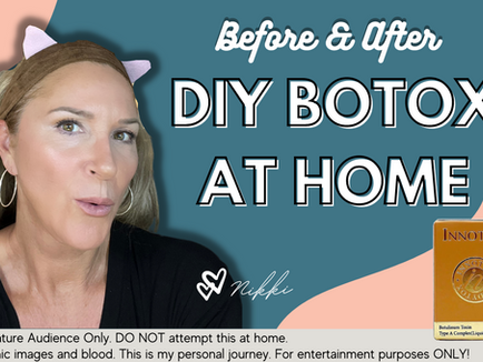 Botox Before & After using Innotox 