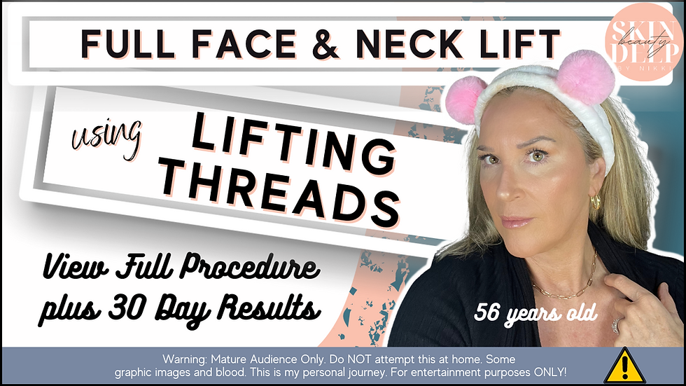 ⛔️ CAUTION - Full Face and Neck Lift with COG Lifting Threads: At-Home with 30 Day Results - I DO NOT RECOMMEND THIS PROCEDURE WITH PLLA or PCL THREAD.