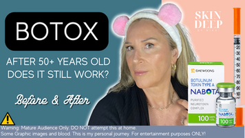 Unveiling the Truth: Does Botox Really Work After 50+?