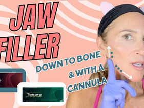 FILLER: How I Define My Jawline with Tesoro Implant & Tesoro SubQ