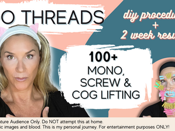 100+ PDO Threads in Face & Neck plus 2 Week Results