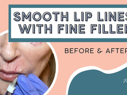 FILLER: Smooth Vertical Lip Lines with Fine Filler.