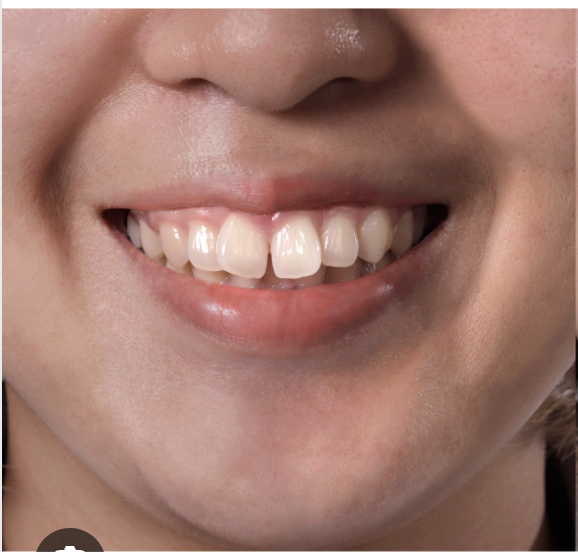 Before: Natural Teeth