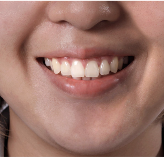 After: Lumina Veneer