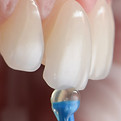 Veneers_© Abarca Dental.jpg