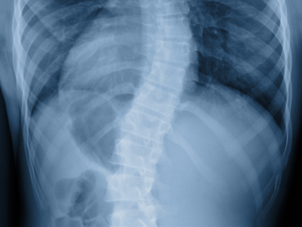 Scoliosis Awareness Month