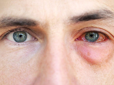 Allergy Symptoms on Eyes | Panoptic Vision