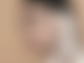 Dermal Fillers