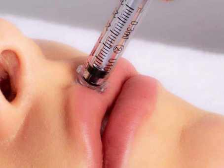 Dermal Fillers FAQ