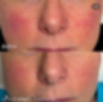 skin renewal with ADVATx Yellow Laser