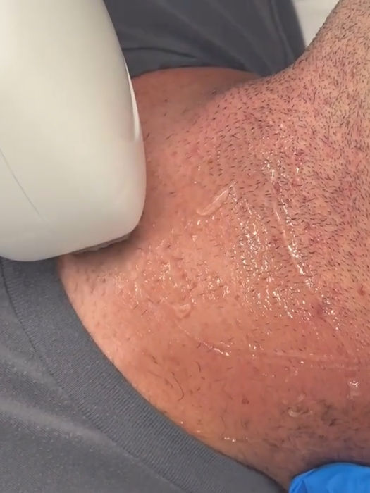 Image of man receiving laser hair removal