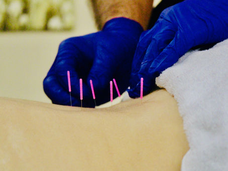 What Is Dry Needling & Why Should I Consider It For Pain Management?