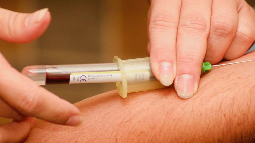 New blood test improves prostate cancer screening