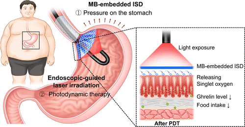 Laser light and a nonsurgical implant could overcome obesity