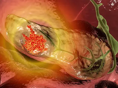 mRNA vaccine can stop pancreatic cancer