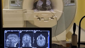 Alzheimer's patients benefit substantially from 40 Hz sensory stimulation