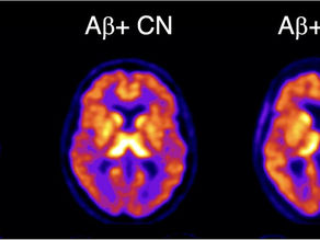 Novel PET scan detects earliest signs of Alzheimer’s disease