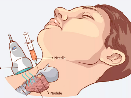 Caroço no Pescoço em Manaus: Tratamento e Biópsia de Linfonodo (Guia Completo)