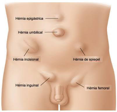 cirurgia de hérnia em manaus